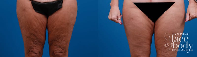 Hidden Thigh Lift Before & After Gallery - Patient 262013 - Image 1