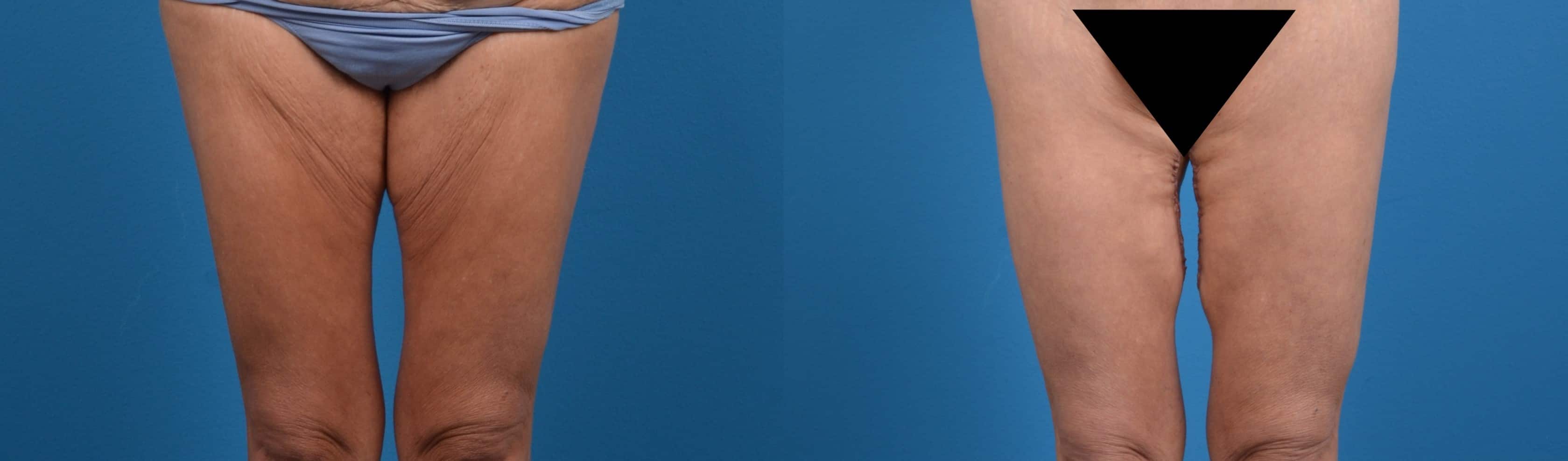 Hidden Thigh Lift Before & After Gallery - Patient 122594060 - Image 1