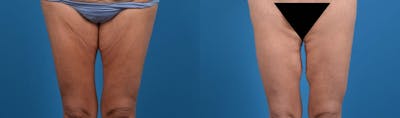 Thigh Lift Before & After Gallery - Patient 112806 - Image 1