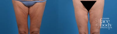 Hidden Thigh Lift Before & After Gallery - Patient 422890 - Image 1