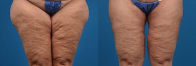Thigh Lift Before & After Gallery - Patient 357494 - Image 1