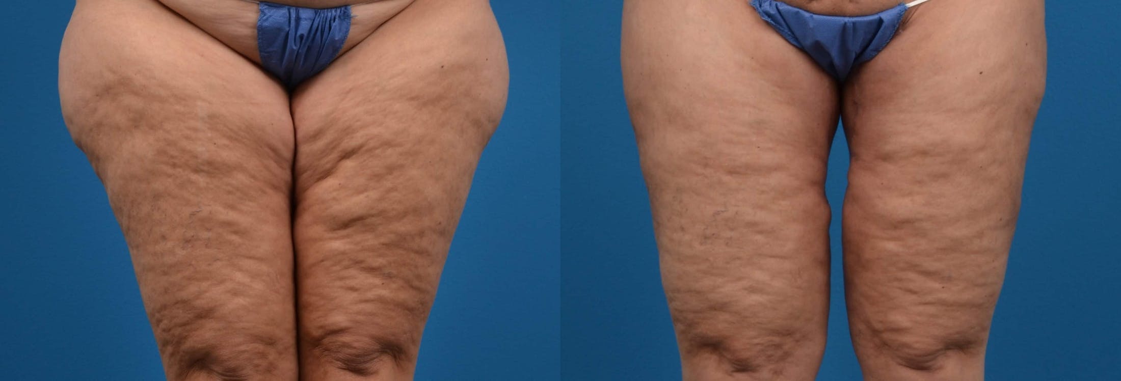 Thigh Lift Before & After Gallery - Patient 122594058 - Image 1