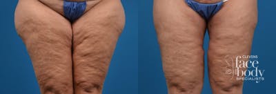 Hidden Thigh Lift Before & After Gallery - Patient 108047 - Image 1