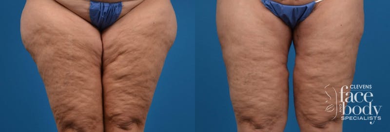 Hidden Thigh Lift Before & After Gallery - Patient 122594058 - Image 1