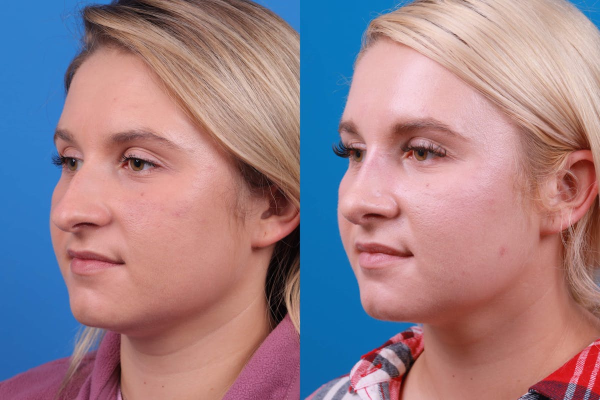 Rhinoplasty Before & After Gallery - Patient 122593919 - Image 5