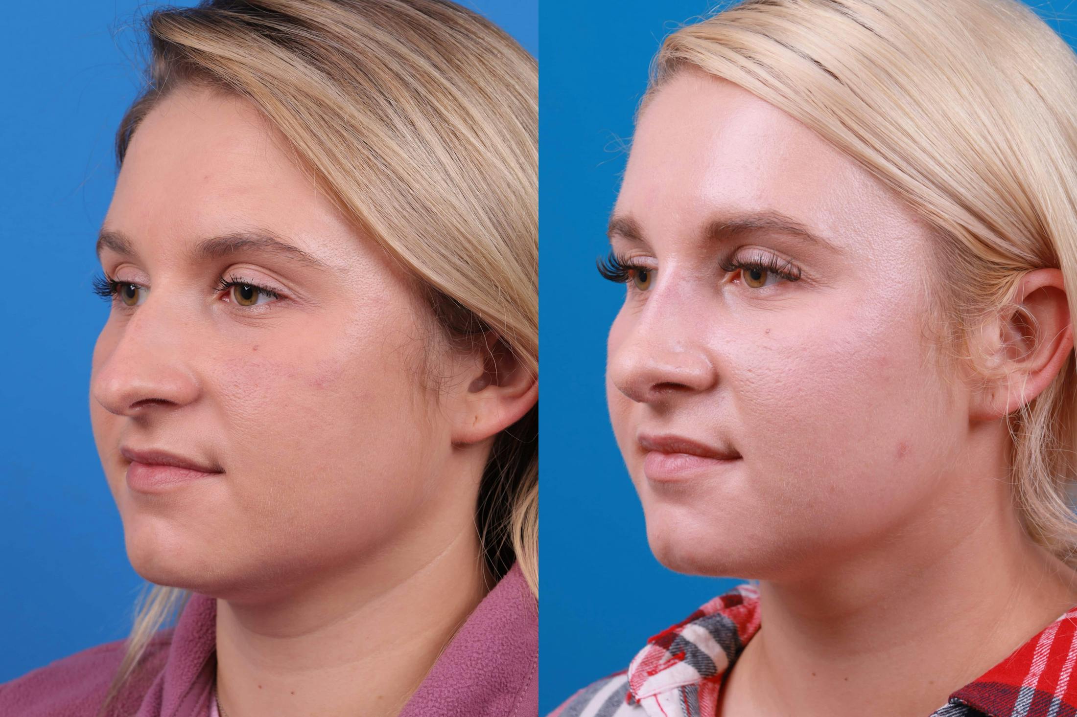 Rhinoplasty Before & After Gallery - Patient 122593919 - Image 5