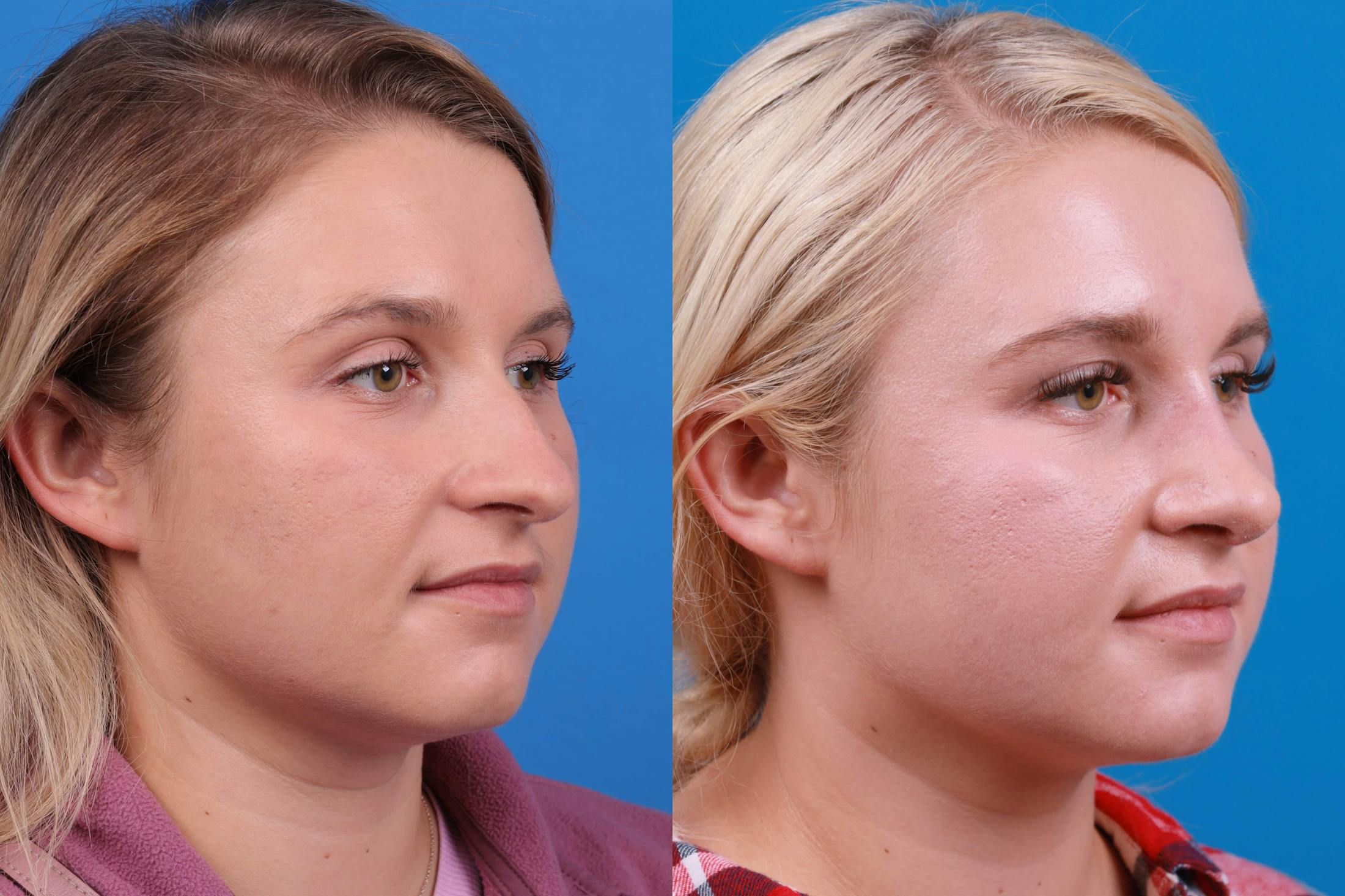 Rhinoplasty Before & After Gallery - Patient 122593919 - Image 4
