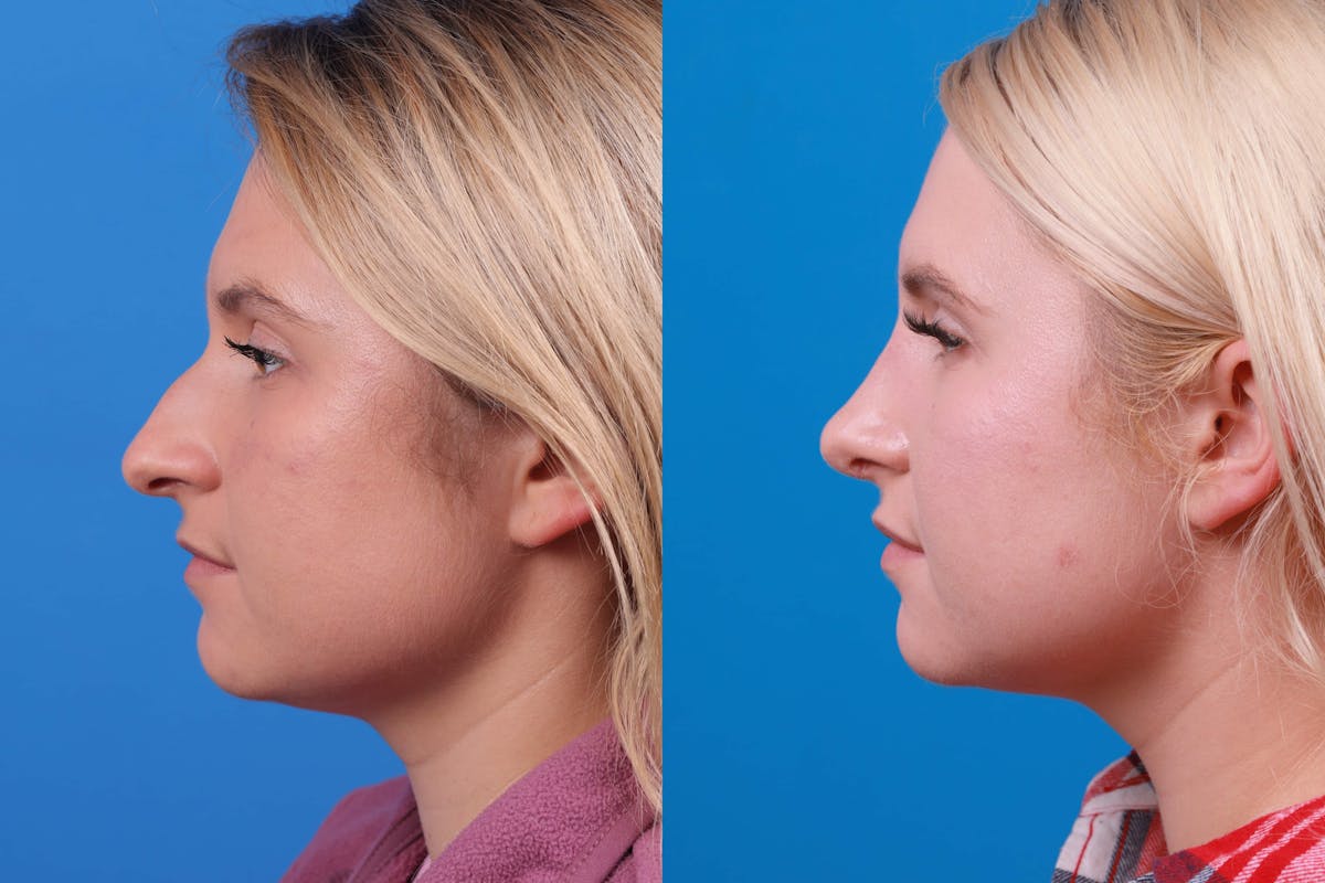Rhinoplasty Before & After Gallery - Patient 122593919 - Image 2