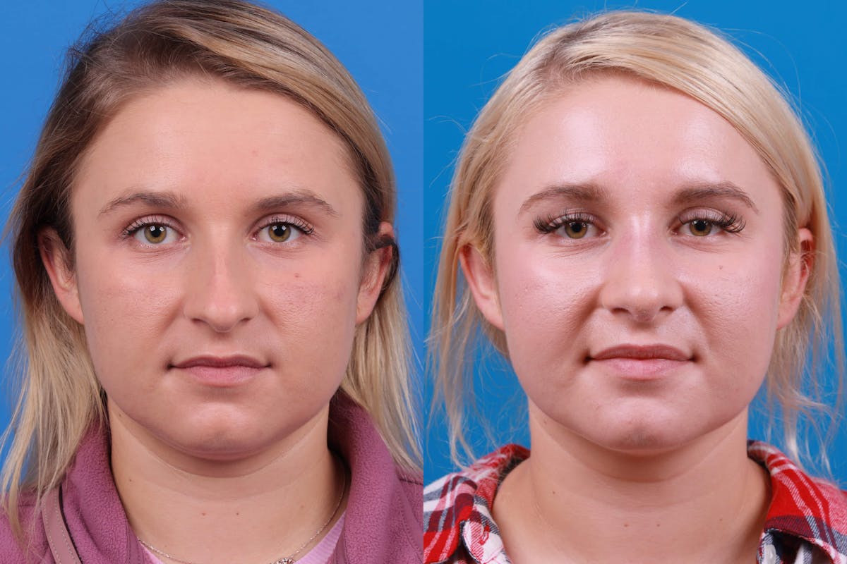 Rhinoplasty Before & After Gallery - Patient 122593919 - Image 3
