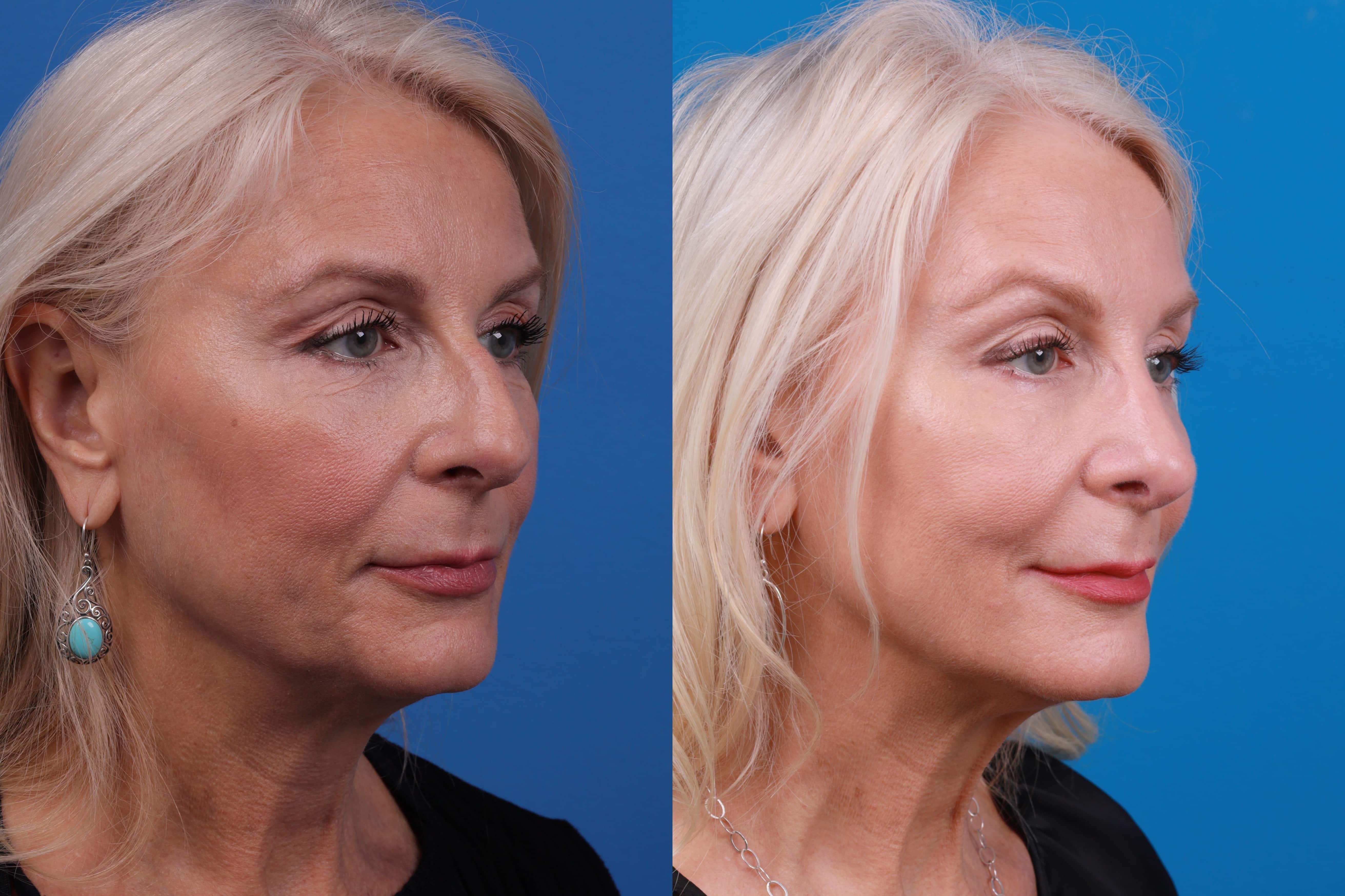 Rhinoplasty Before & After Gallery - Patient 122406987 - Image 5