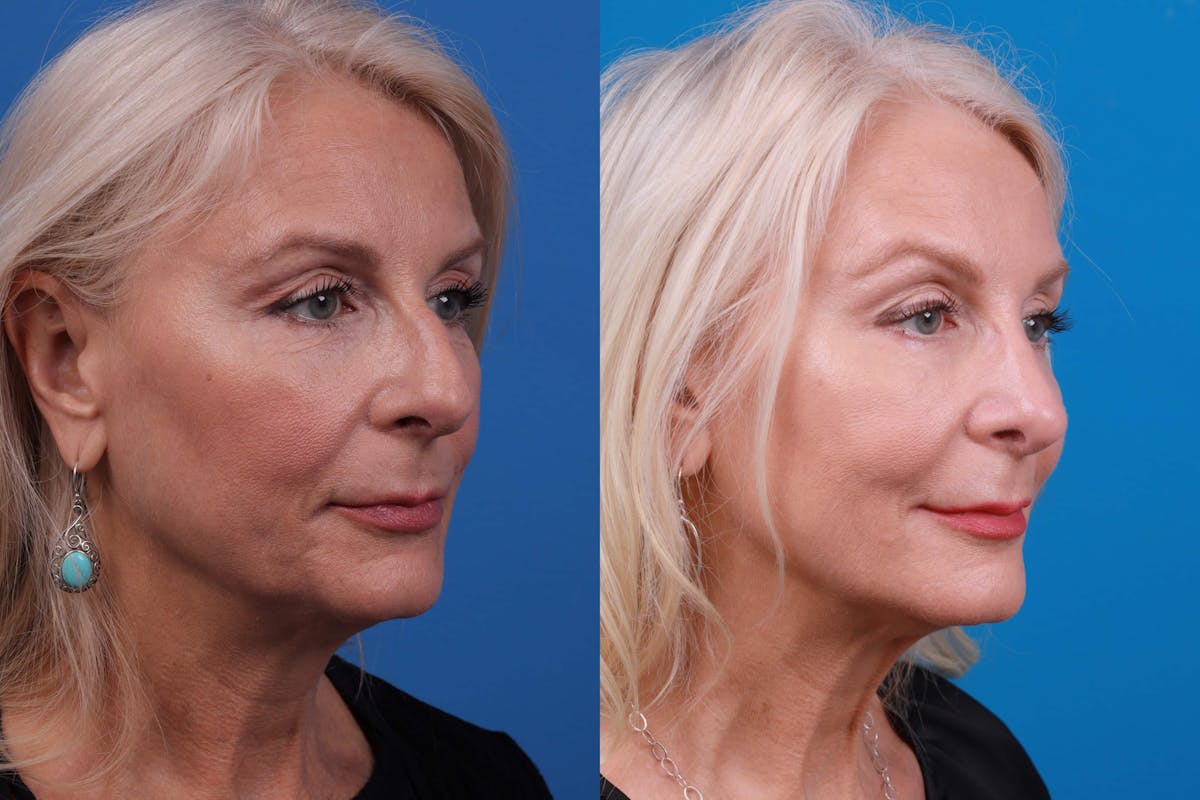 Rhinoplasty Before & After Gallery - Patient 122406987 - Image 5
