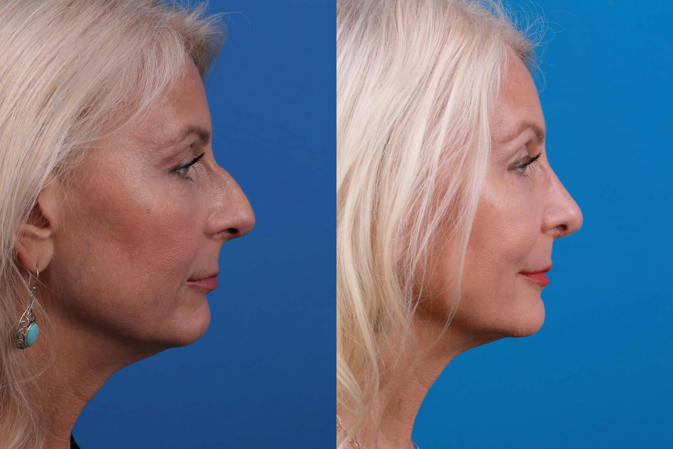 Rhinoplasty Before & After Gallery - Patient 122406987 - Image 4