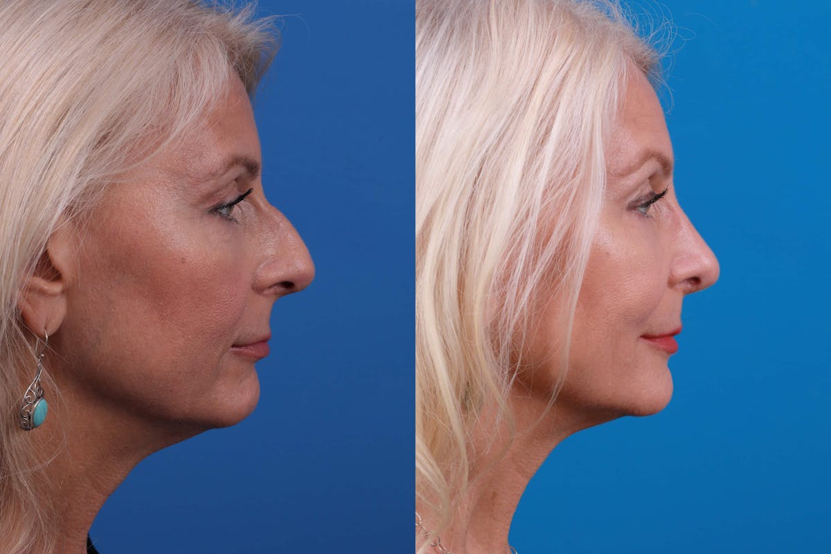 Rhinoplasty Before & After Gallery - Patient 122406987 - Image 4