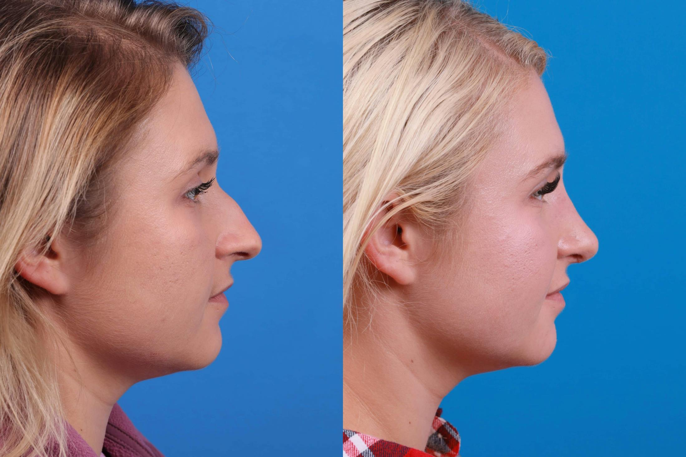 Rhinoplasty Before & After Gallery - Patient 122593919 - Image 1