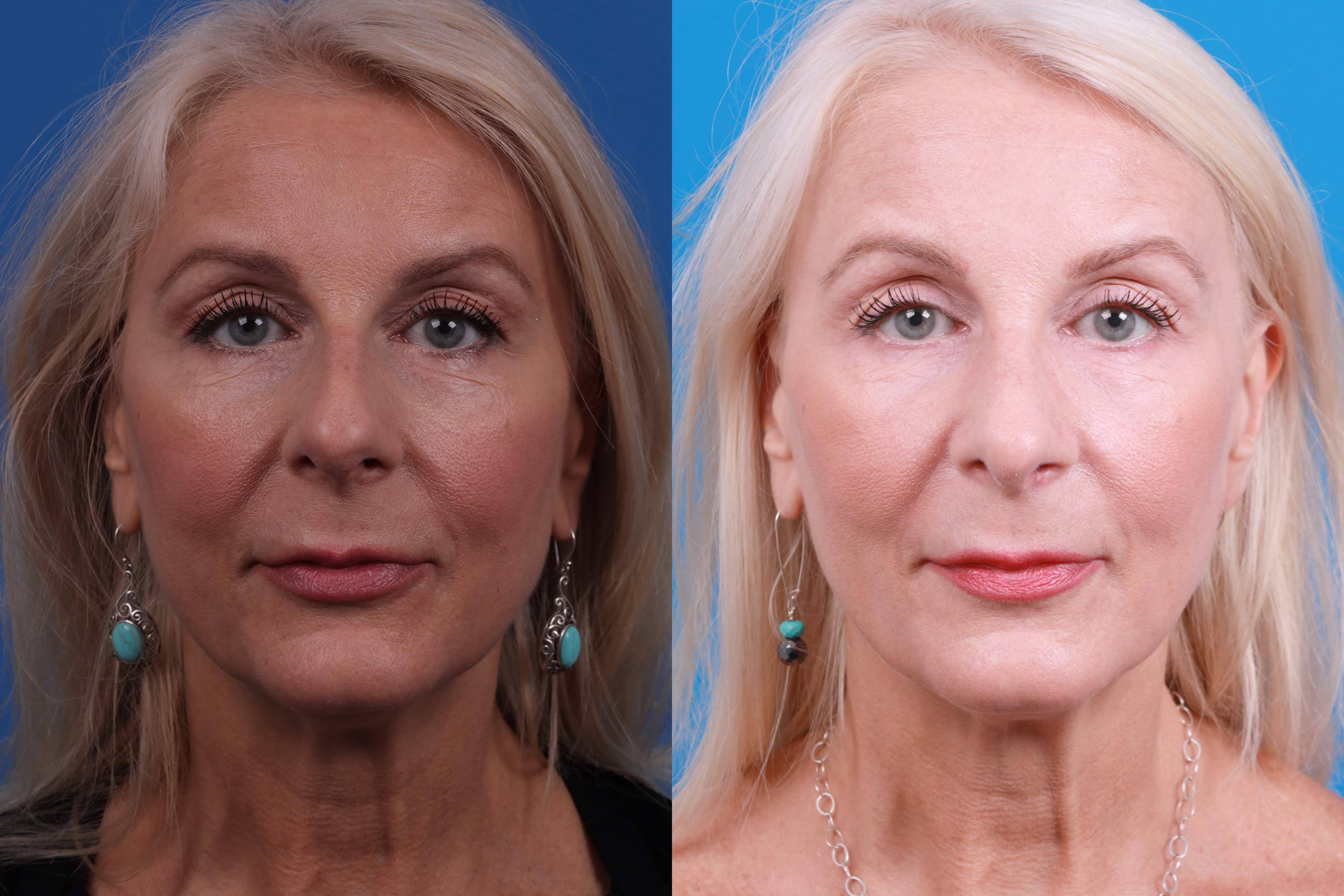 Rhinoplasty Before & After Gallery - Patient 122406987 - Image 3