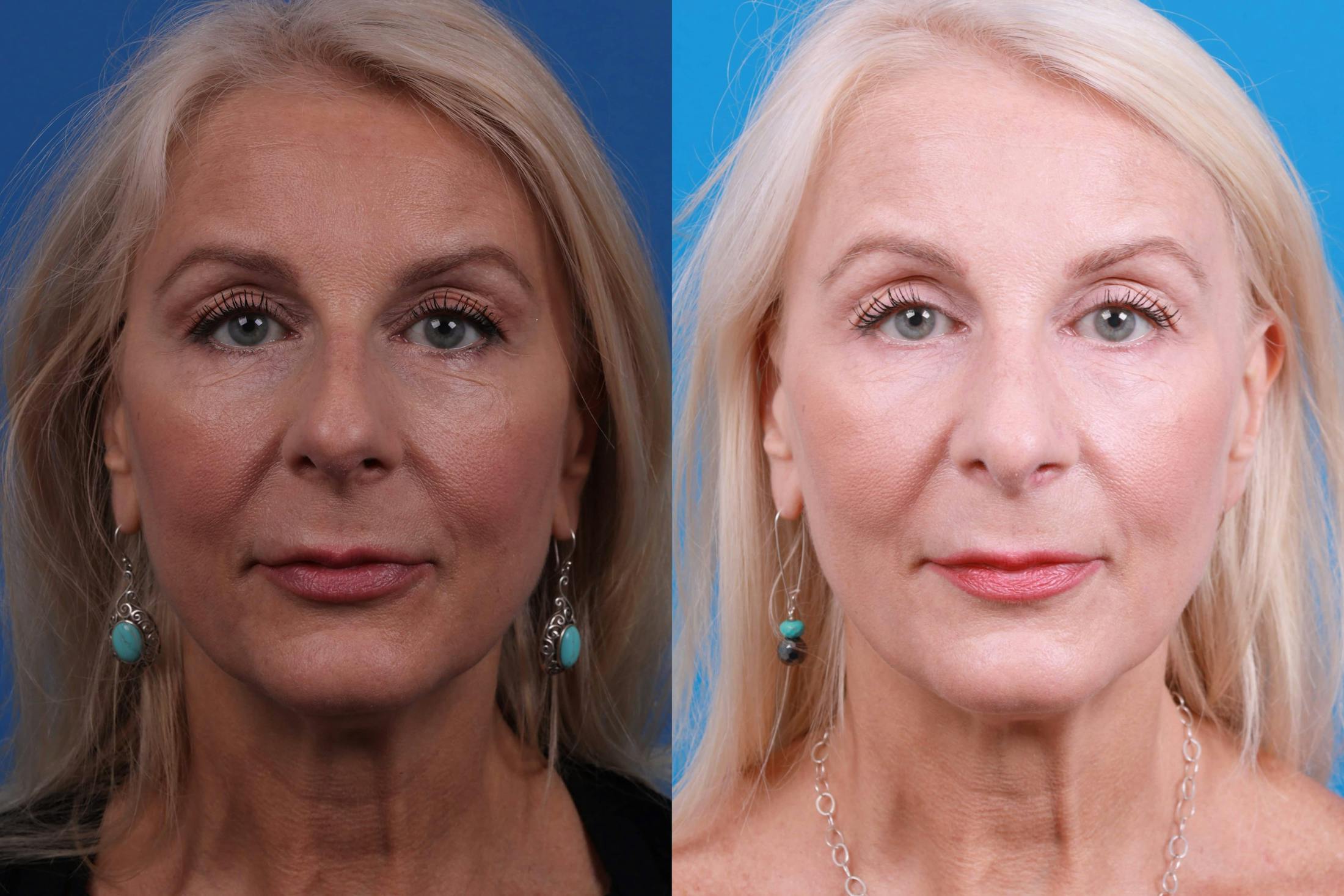 Rhinoplasty Before & After Gallery - Patient 122406987 - Image 3