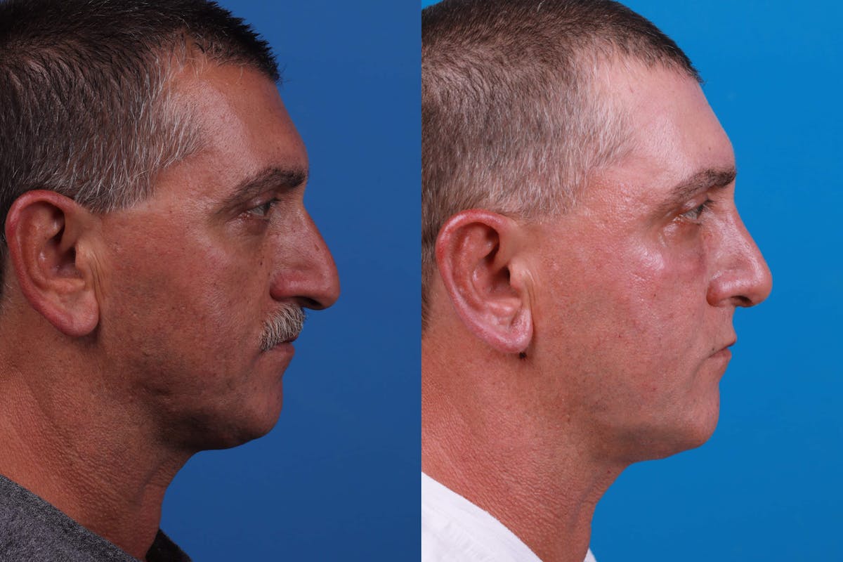 Rhinoplasty Before & After Gallery - Patient 122593918 - Image 2