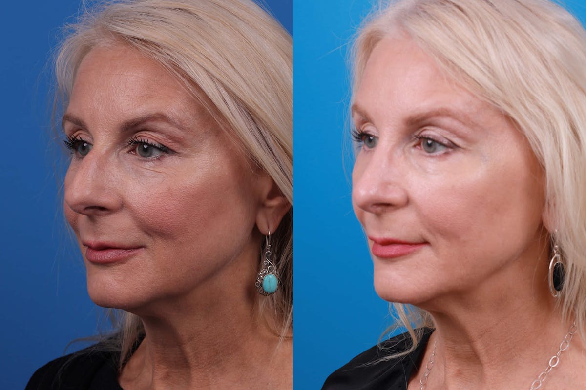 Rhinoplasty Before & After Gallery - Patient 122406987 - Image 2