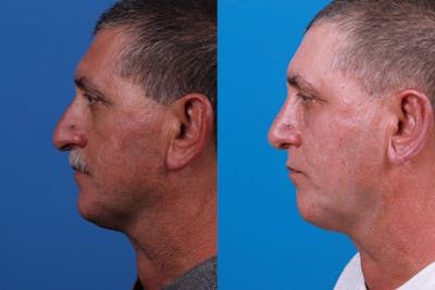 Rhinoplasty Before & After Gallery - Patient 122593918 - Image 1