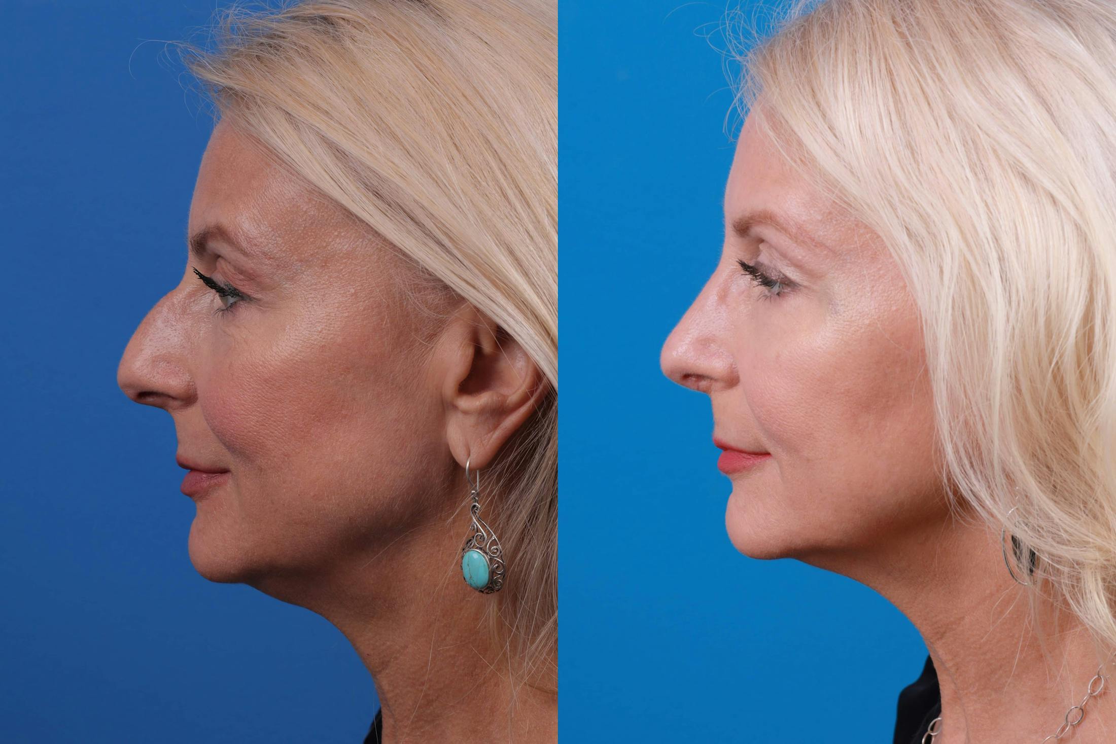 Rhinoplasty Before & After Gallery - Patient 122406987 - Image 1