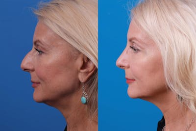 Rhinoplasty Before & After Gallery - Patient 122406987 - Image 1