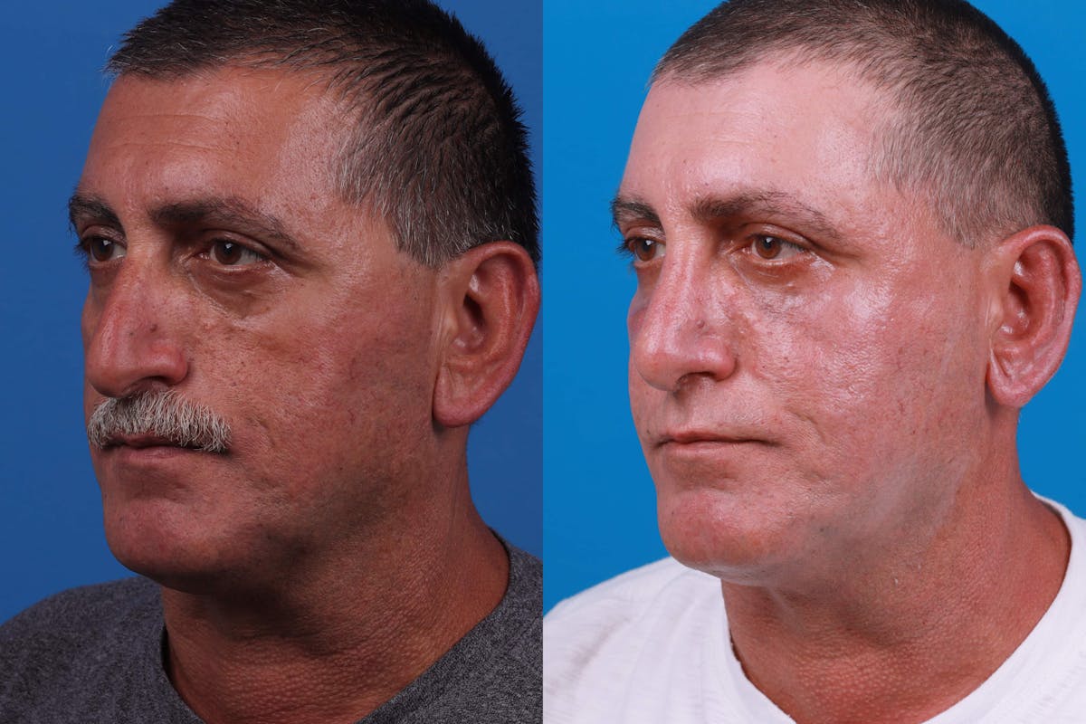 Rhinoplasty Before & After Gallery - Patient 122593918 - Image 5