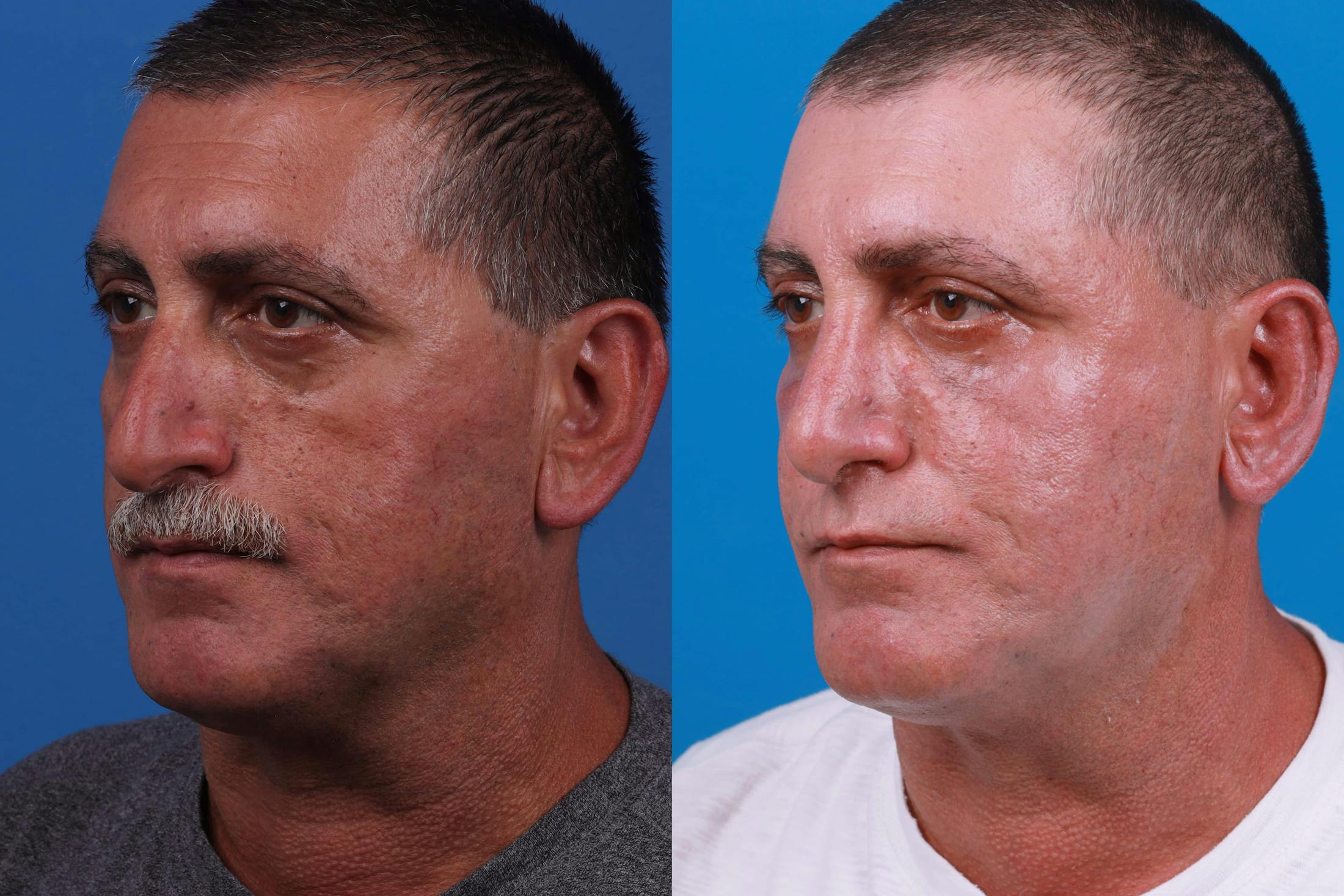 Rhinoplasty Before & After Gallery - Patient 122593918 - Image 5