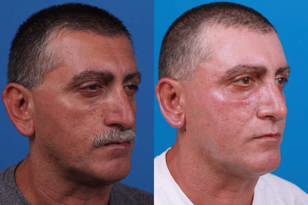 Rhinoplasty Before & After Gallery - Patient 122593918 - Image 4