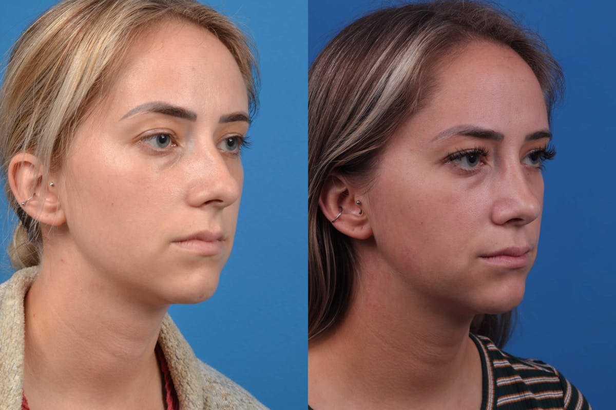 Rhinoplasty Before & After Gallery - Patient 122593917 - Image 5