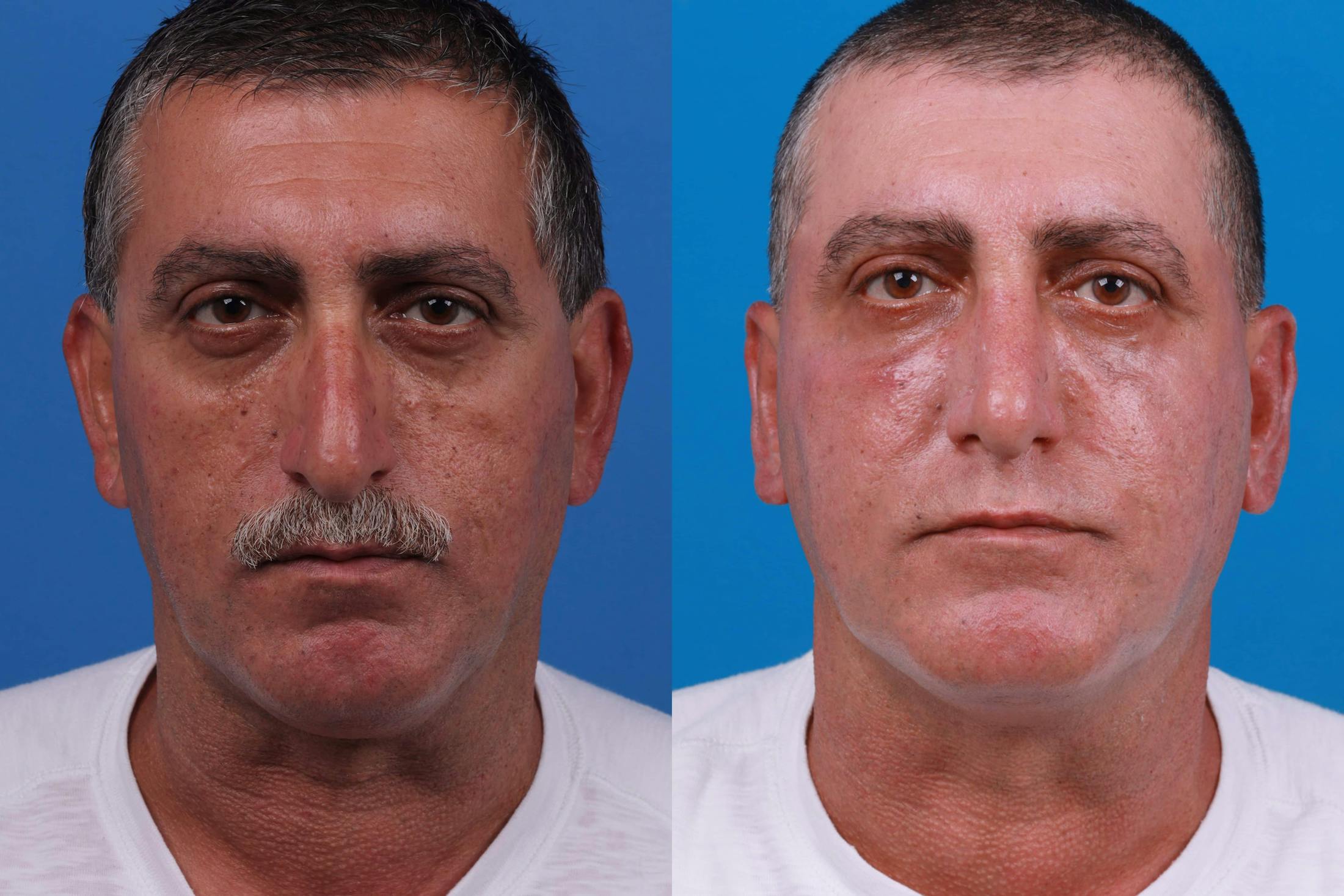 Rhinoplasty Before & After Gallery - Patient 122593918 - Image 3