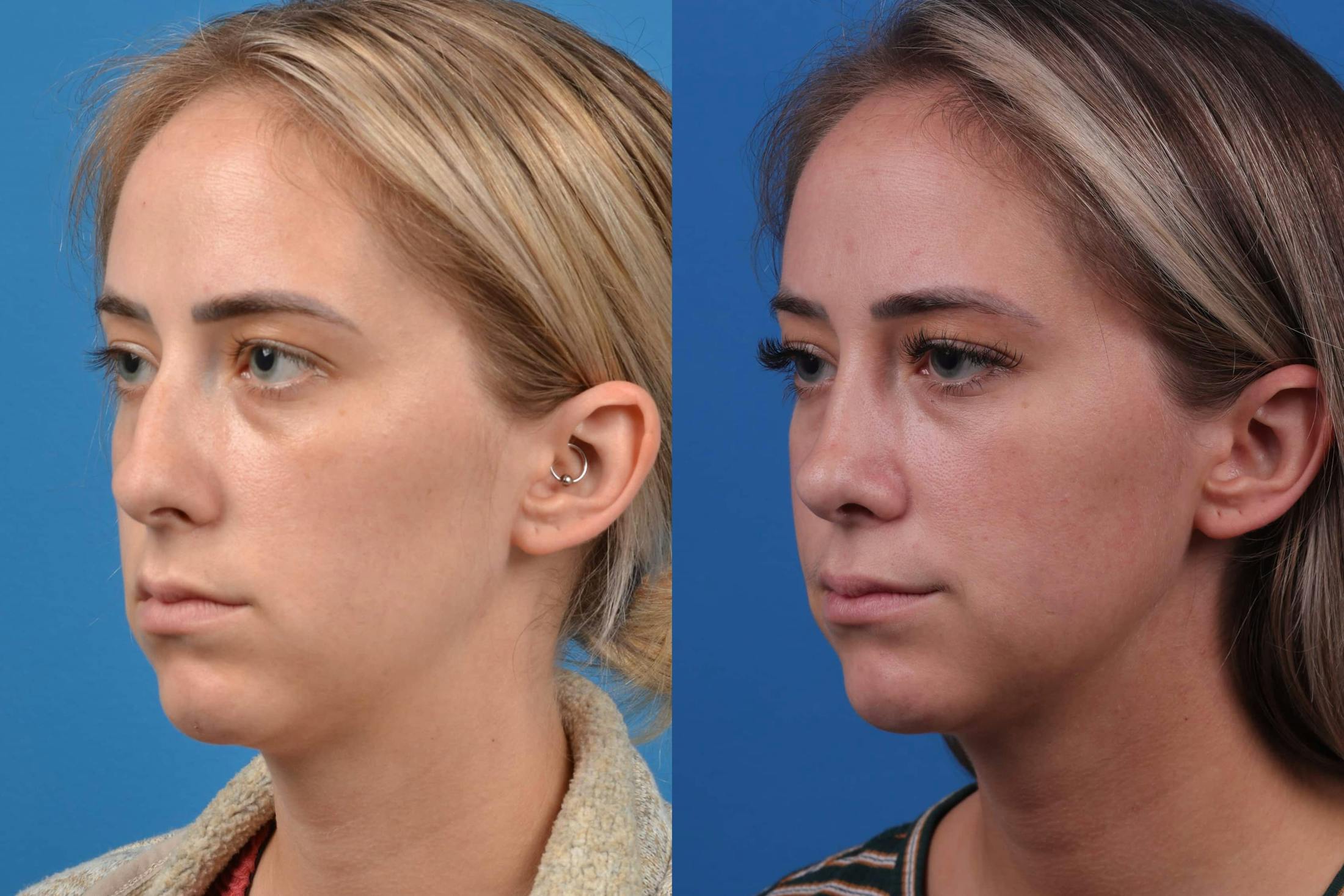 Rhinoplasty Before & After Gallery - Patient 122593917 - Image 4