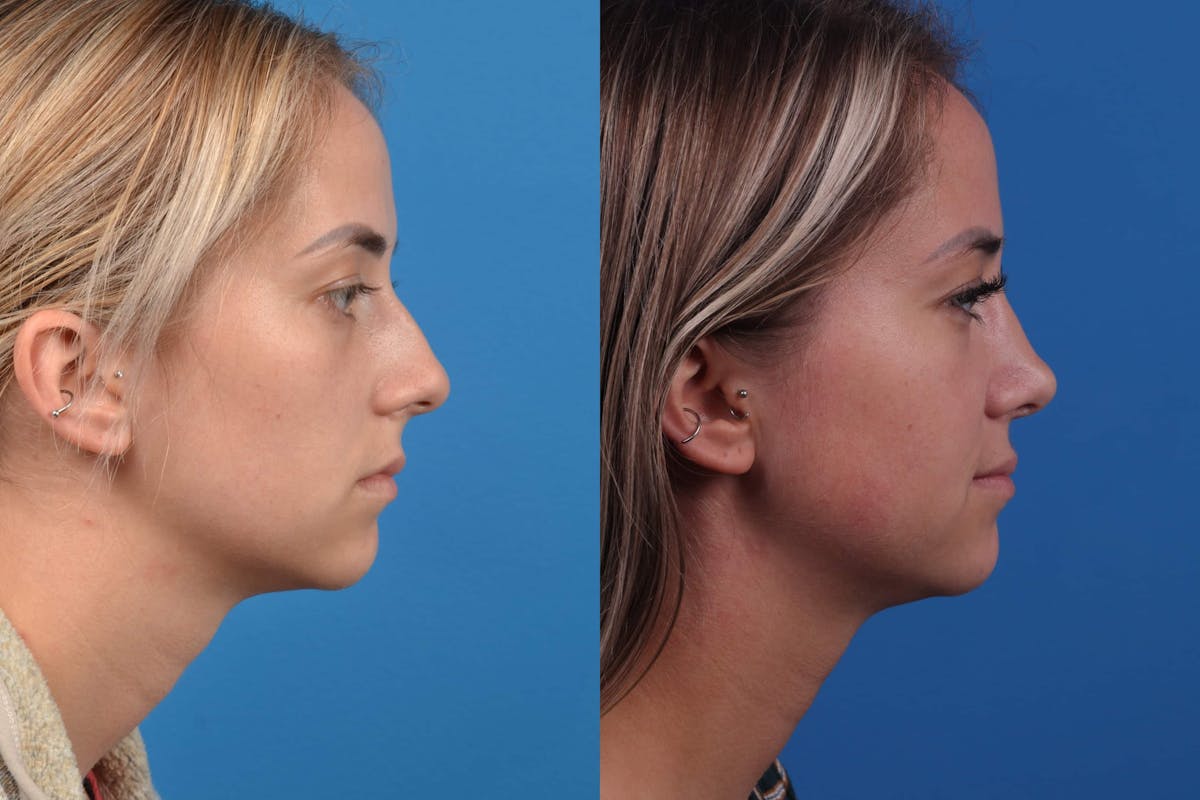 Rhinoplasty Before & After Gallery - Patient 122593917 - Image 2