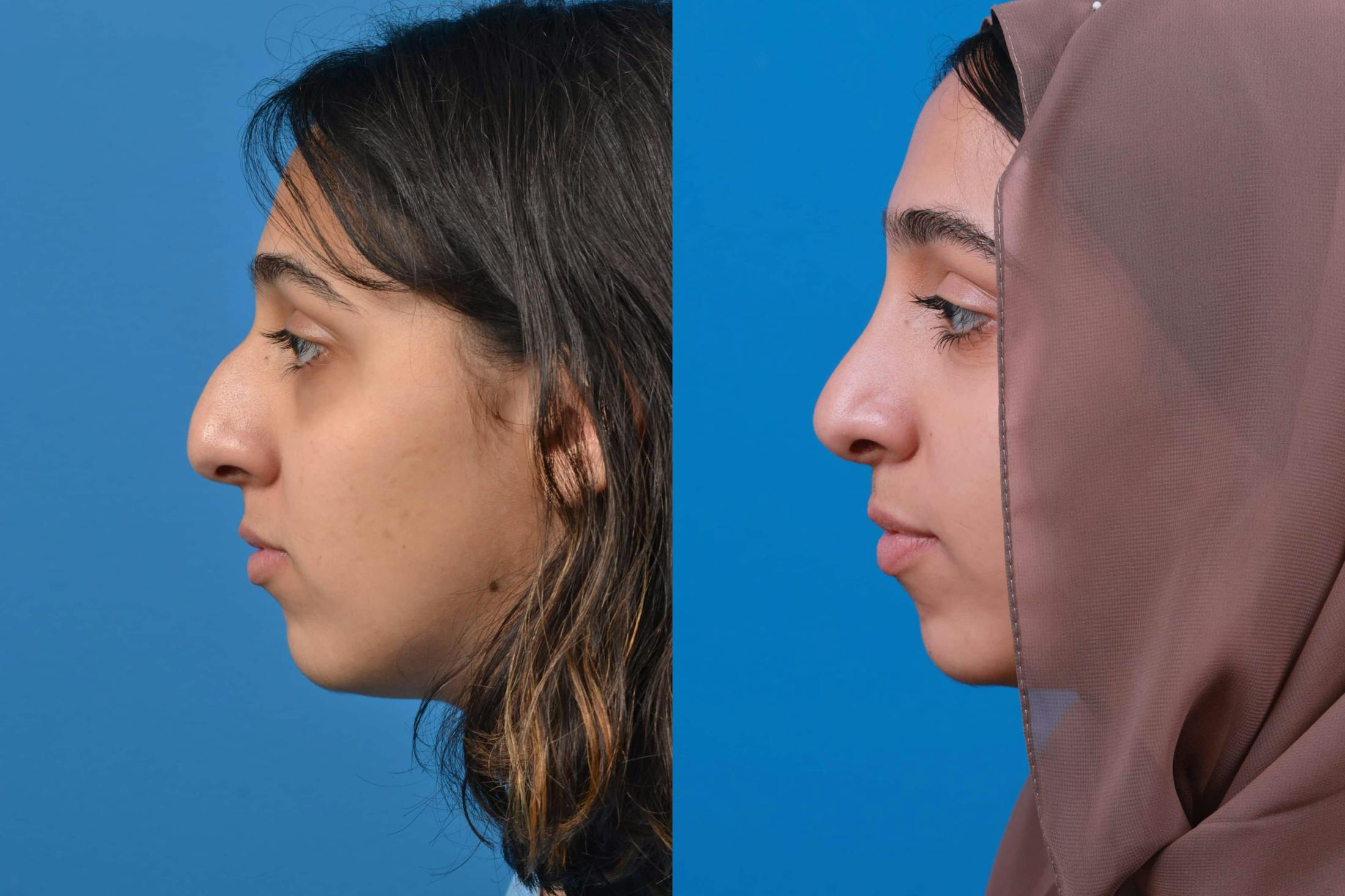 Rhinoplasty Before & After Gallery - Patient 122593916 - Image 2