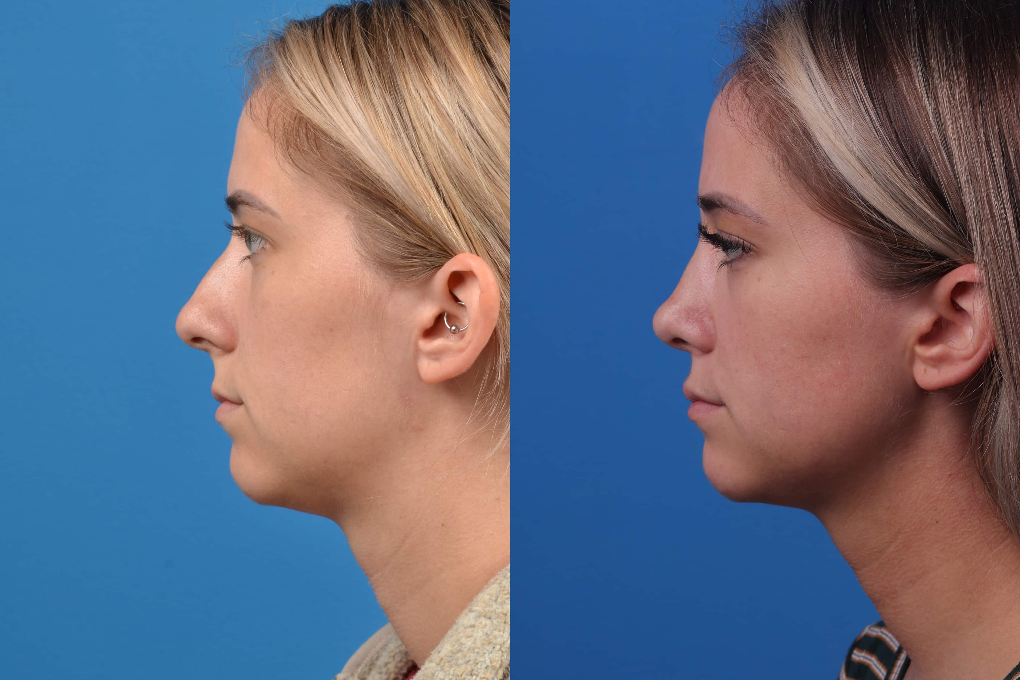 Rhinoplasty Before & After Gallery - Patient 122593917 - Image 1