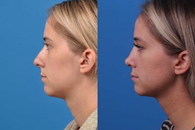 Rhinoplasty Before & After Gallery - Patient 122593917 - Image 1
