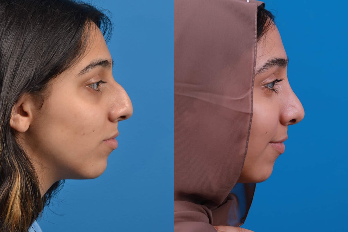 Rhinoplasty Before & After Gallery - Patient 122593916 - Image 1