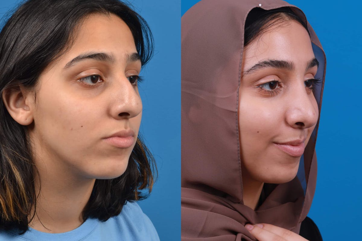 Rhinoplasty Before & After Gallery - Patient 122593916 - Image 5
