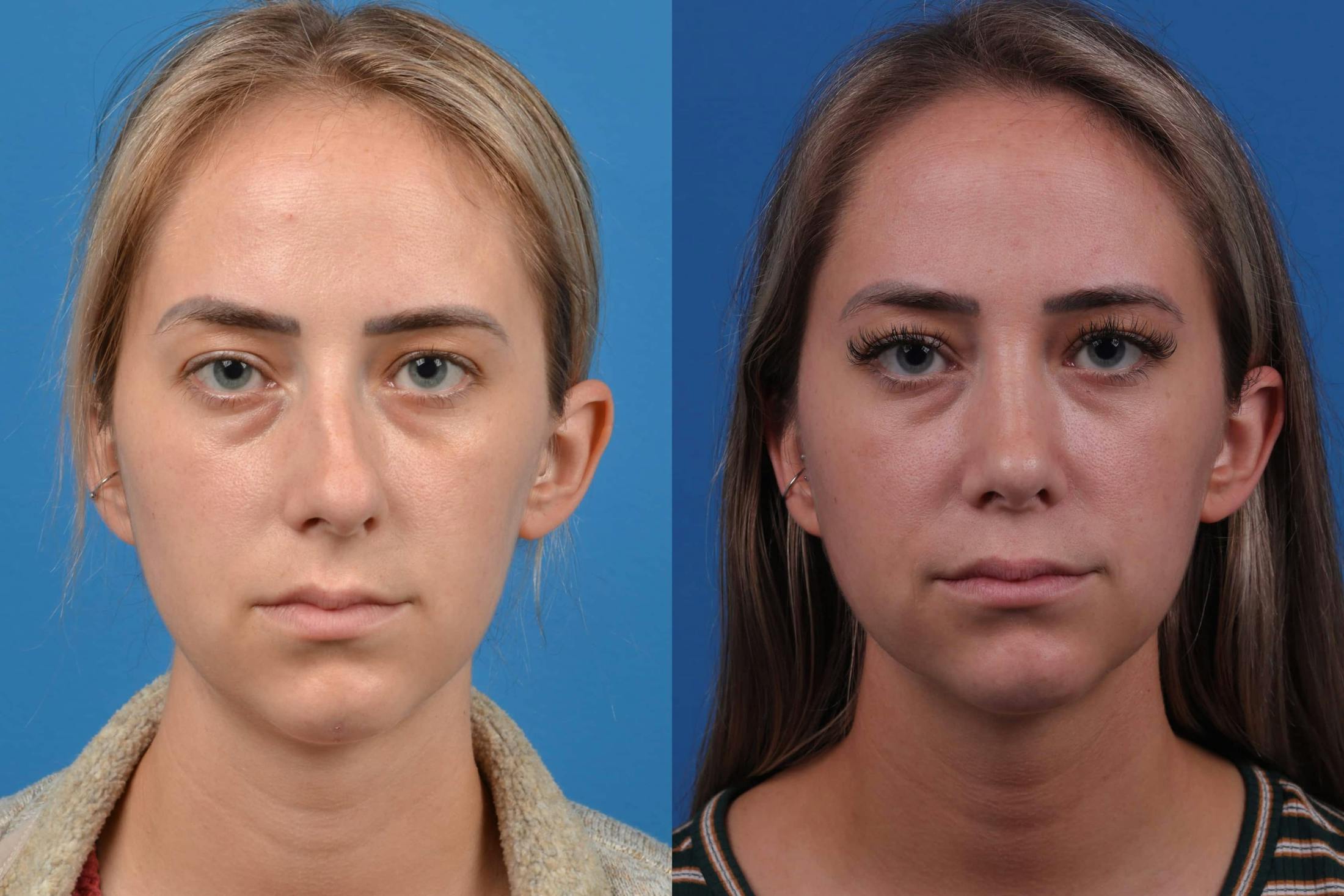 Rhinoplasty Before & After Gallery - Patient 122593917 - Image 3