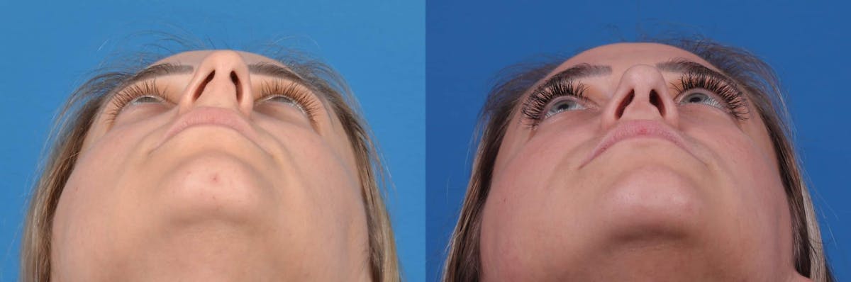 Rhinoplasty Before & After Gallery - Patient 122593917 - Image 6