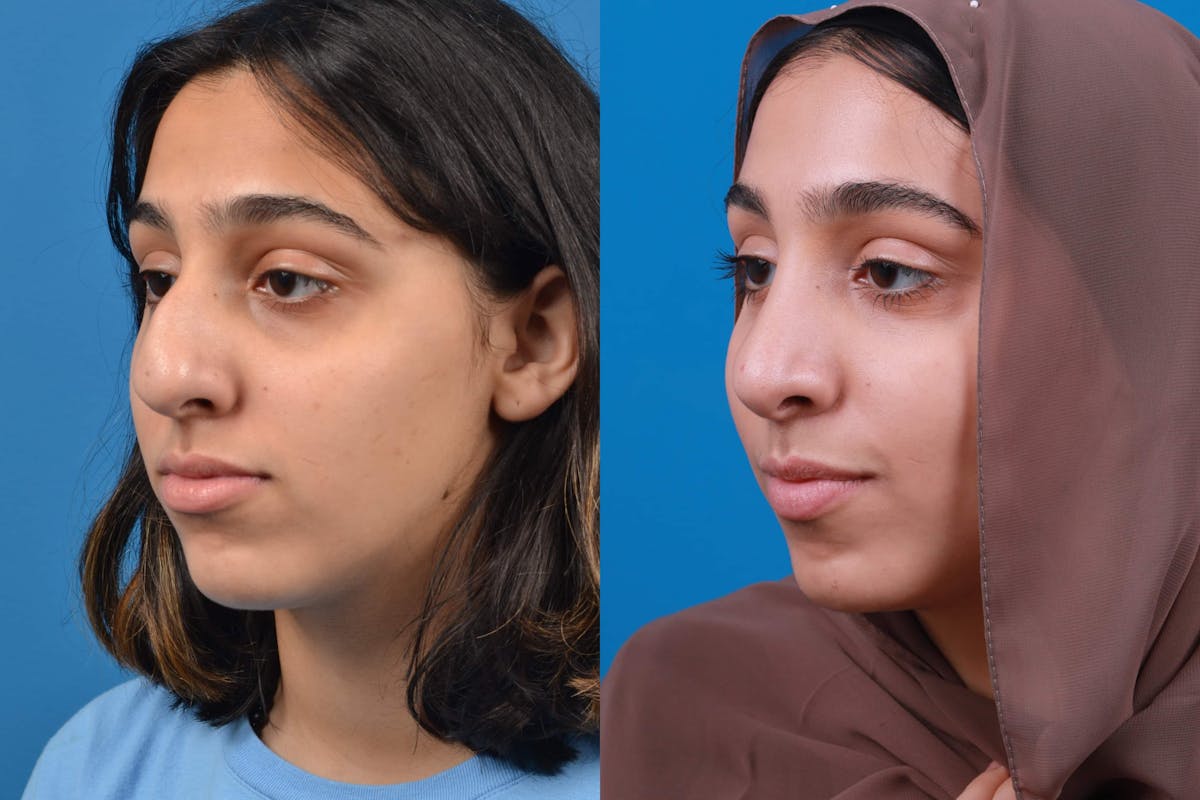 Rhinoplasty Before & After Gallery - Patient 122593916 - Image 4