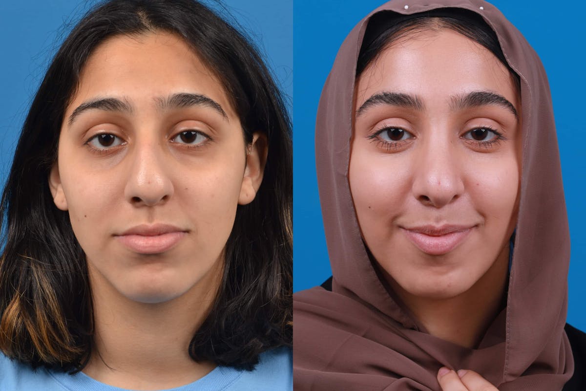 Rhinoplasty Before & After Gallery - Patient 122593916 - Image 3