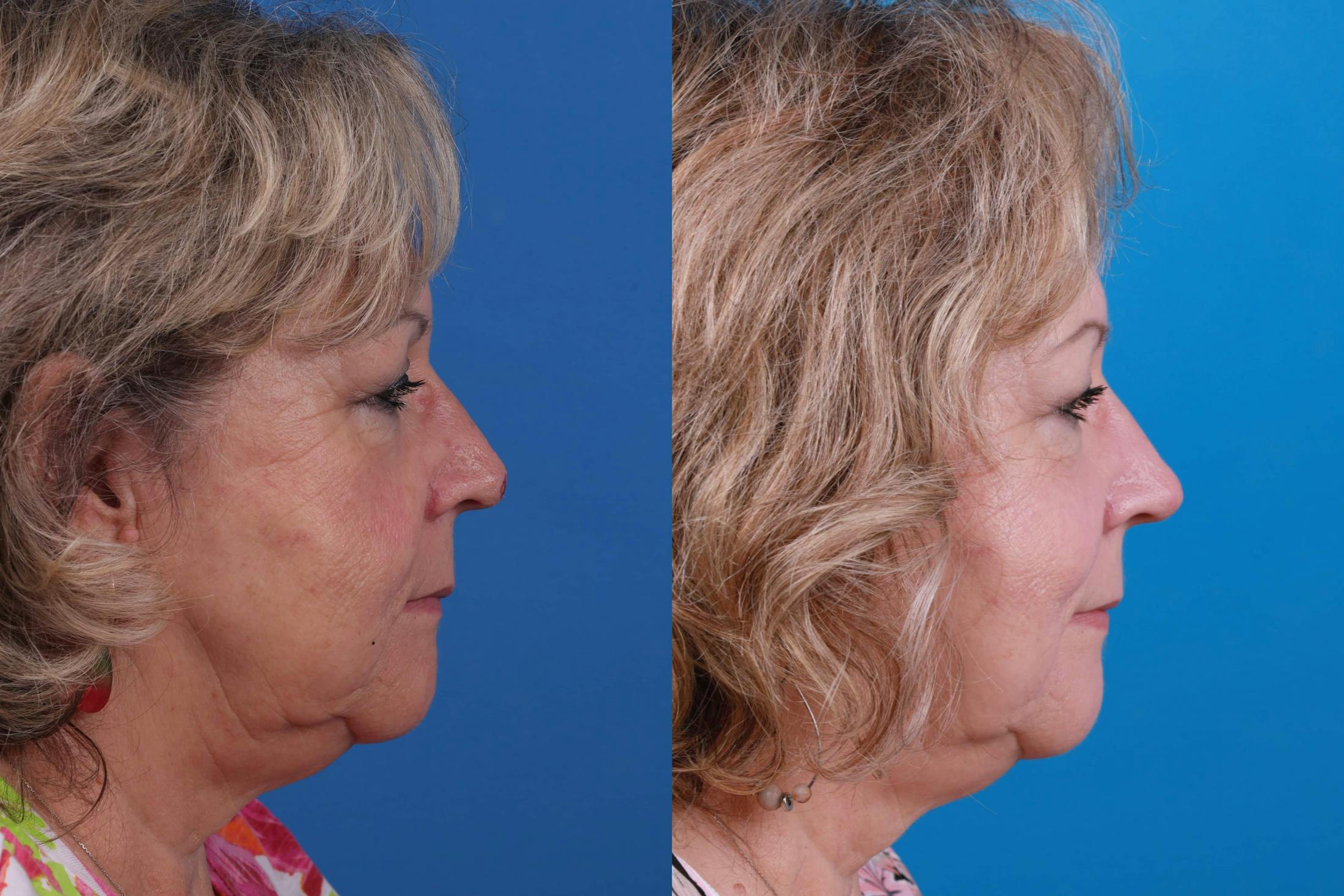 Mohs Surgery and Skin Cancer Before & After Gallery - Patient 122593786 - Image 4