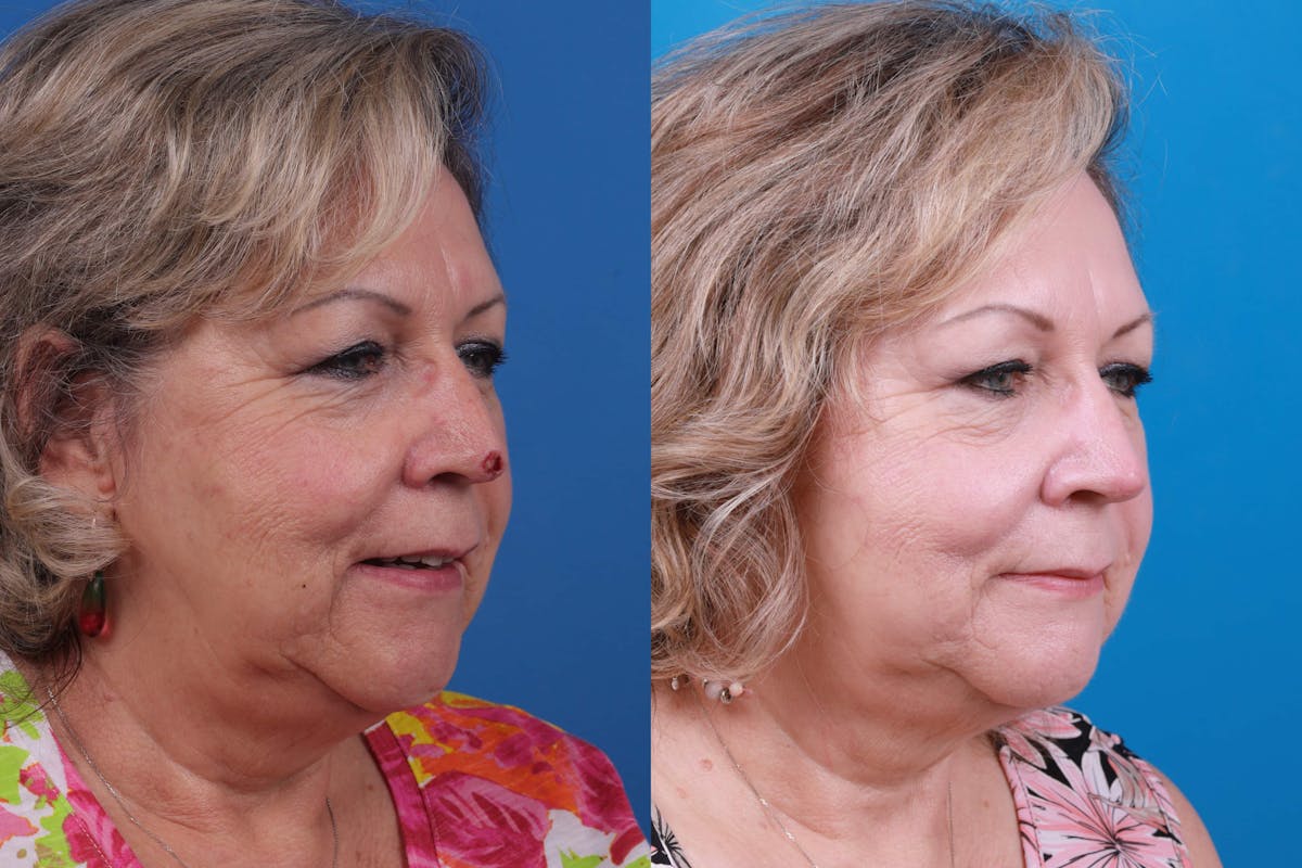 Mohs Surgery and Skin Cancer Before & After Gallery - Patient 122593786 - Image 3