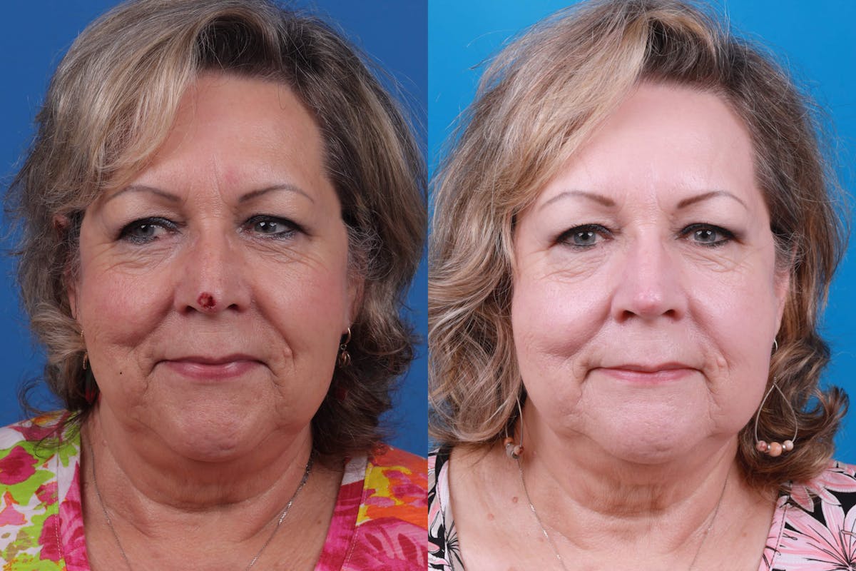 Mohs Surgery and Skin Cancer Before & After Gallery - Patient 122593786 - Image 2