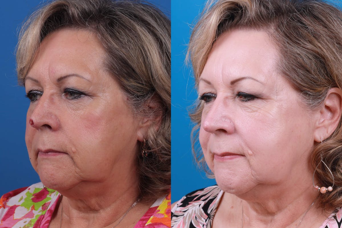 Mohs Surgery and Skin Cancer Before & After Gallery - Patient 122593786 - Image 1
