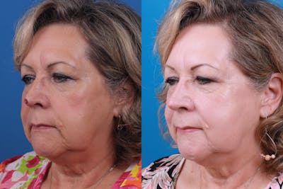 Mohs Surgery and Skin Cancer Before & After Gallery - Patient 122593786 - Image 1