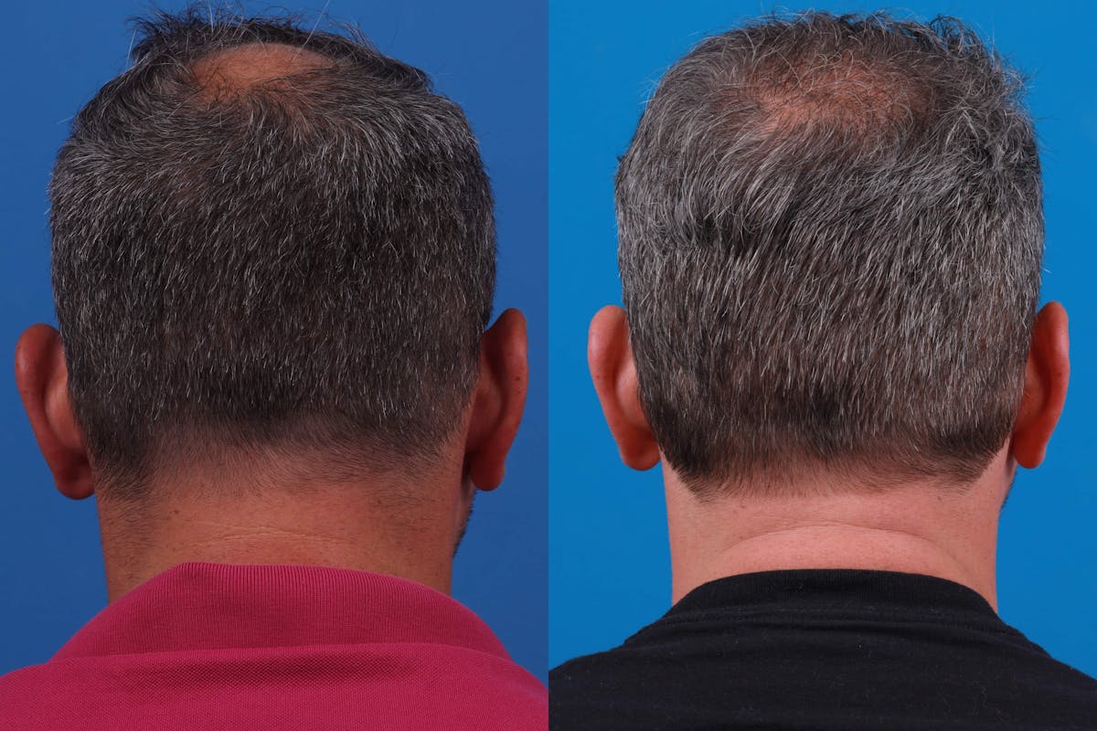 Hair Restoration Before & After Gallery - Patient 122593738 - Image 3