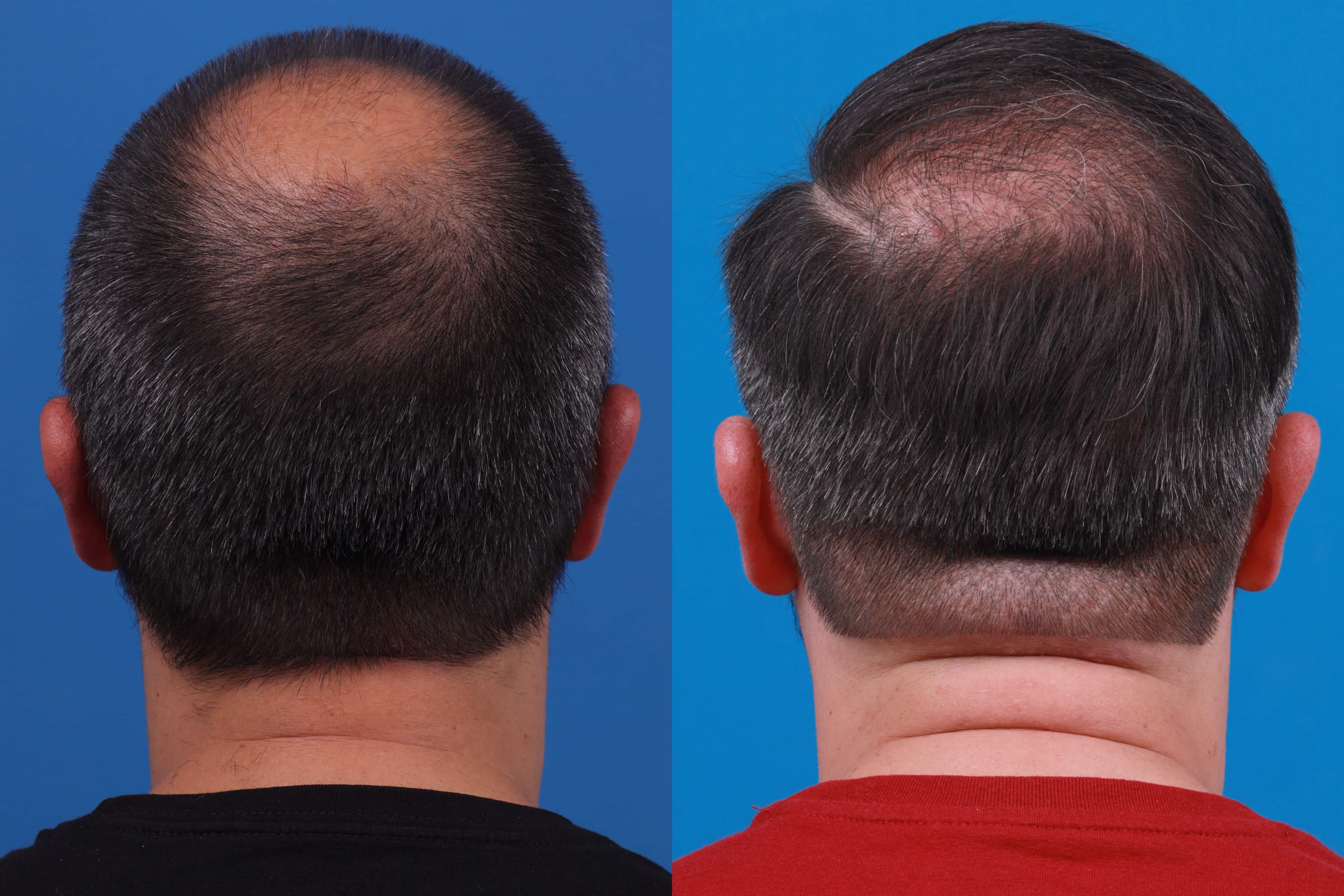 Hair Restoration Before & After Gallery - Patient 122593737 - Image 4