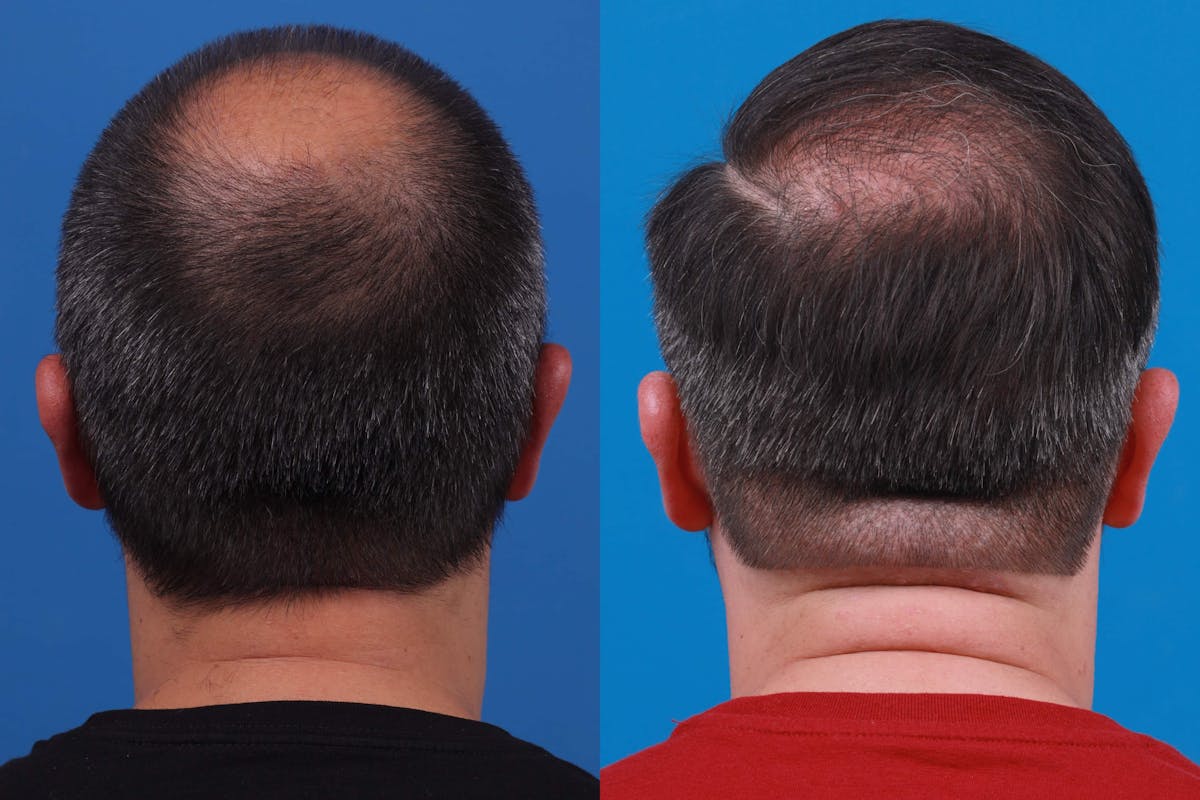 Hair Restoration Before & After Gallery - Patient 122593737 - Image 4