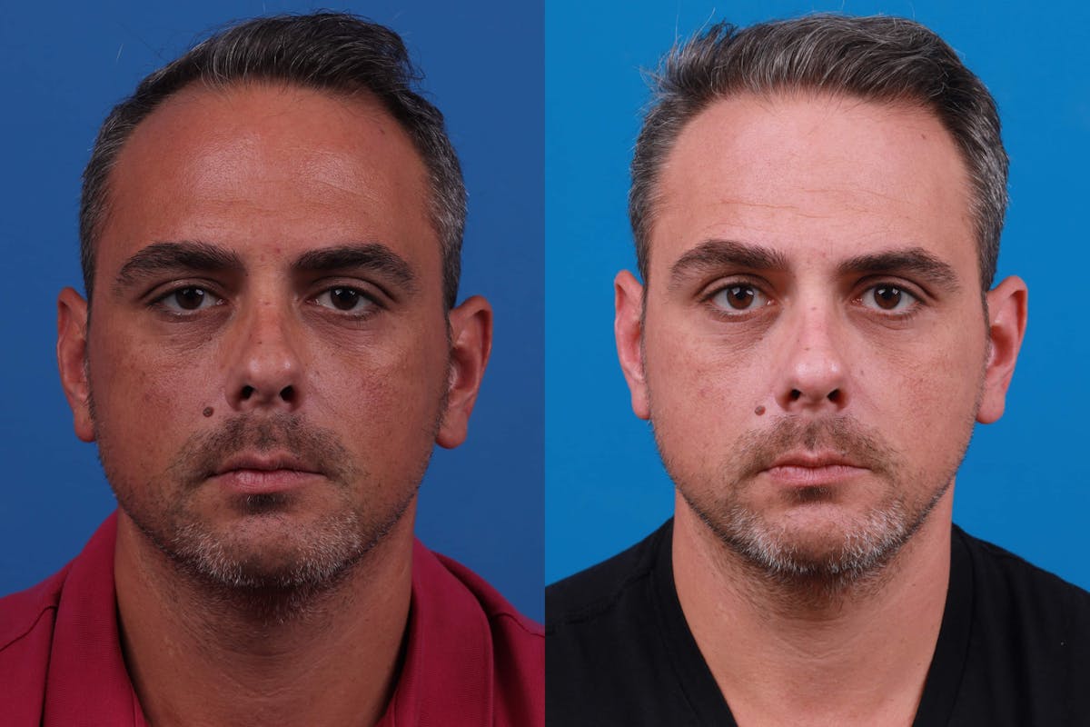 Hair Restoration Before & After Gallery - Patient 122593738 - Image 2